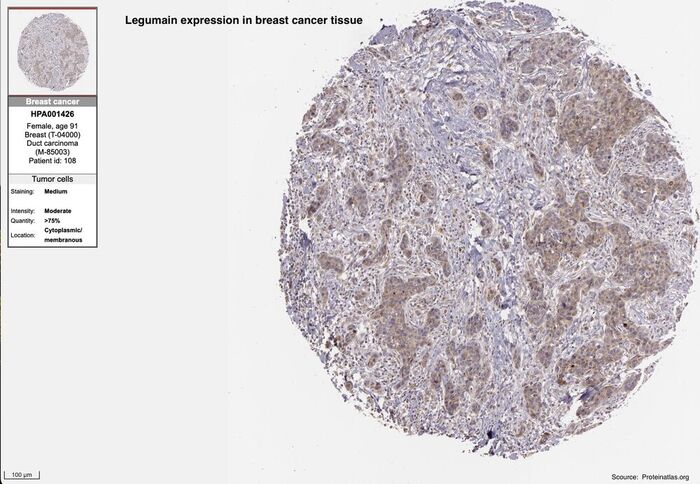 Legumain expression in primary breast cancer tissue